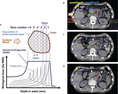 Robust treatment planning in scanned carbon-ion radiotherapy for pancreatic cancer: Clinical verification using in-room computed tomography images